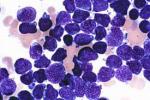Acute Lymphocytic Leukemia (ALL) : étude de marché pharmaceutique