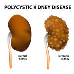 Adult Polycystic Kidney Disease : étude de marché pharmaceutique