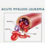 Acute Myelogenous Leukemia (AML) : étude de marché pharmaceutique